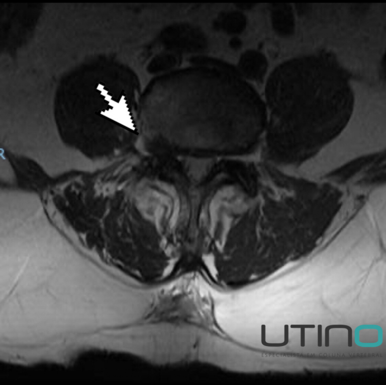 Cirurgia Minimamente Invasiva De Hérnia De Disco Dr Edgar Utino 9839